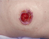 Désinsertion (désunion ou rupture anormale entre la stomie et peau)